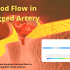 Blood Flow In Clogged Artery