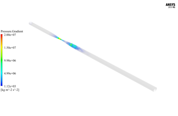 Blood Flow in Clogged Artery CFD Simulation by ANSYS Fluent Training ...