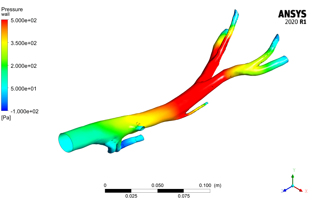 Blood Flow in Clogged Artery CFD Simulation by ANSYS Fluent Training - MR  CFD