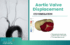 Aortic Valve